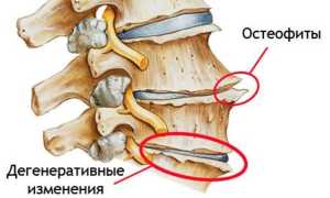 Что такое остеофиты на позвоночнике и их влияние на здоровье