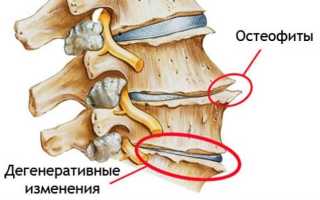 Что такое остеофиты на позвоночнике и их влияние на здоровье