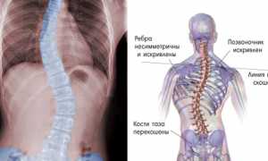 Какие упражнения нельзя делать при сколиозе для здоровья спины