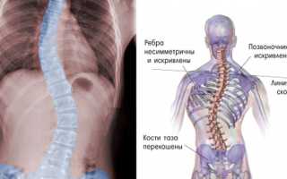 Какие упражнения нельзя делать при сколиозе для здоровья спины