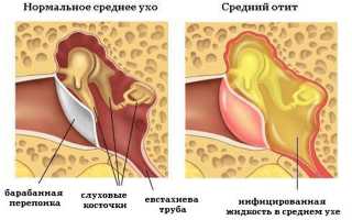 Причины образования жидкости в ухе и их последствия