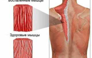 Миозит код по МКБ-10: причины и симптомы