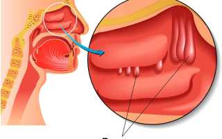 Характерные признаки появления полипов в носу: что нужно знать