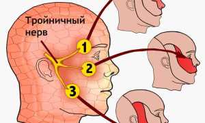 Защемление тройничного нерва: причины и лечение