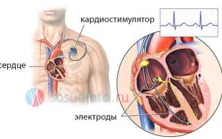 Искусственный водитель ритма
