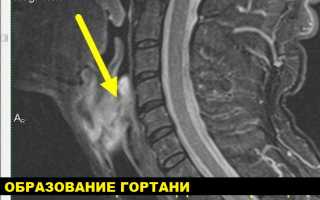 Подготовка к МРТ гортани и горла: важные рекомендации и советы