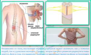 Таблетки от радикулита: эффективные решения для облегчения боли