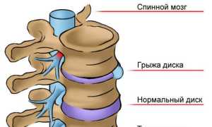 Реабилитация после удаления грыжи позвоночника поясничного отдела: важные рекомендации и советы