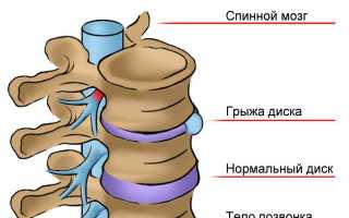 Реабилитация после удаления грыжи позвоночника поясничного отдела: важные рекомендации и советы
