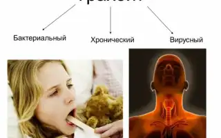 Проверенные методы лечения трахеита у взрослых и детей
