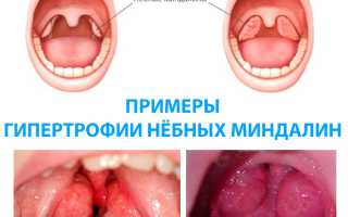 Чем вызвана гипертрофия небных миндалин и как оно проявляется и лечится у детей?