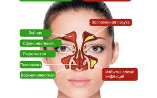 Как проявляется гайморит у взрослых? Симптомы и лечение