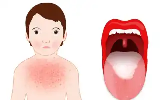 Симптомы и способы заражения скарлатиной у взрослых: важная информация