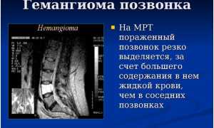 Гемангиома шейного отдела позвоночника: причины и лечение