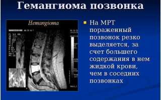 Гемангиома шейного отдела позвоночника: причины и лечение