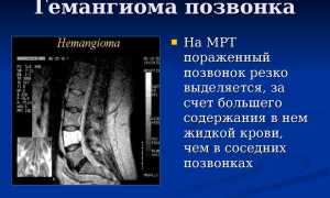 Гемангиолипома позвонка: причины и лечение