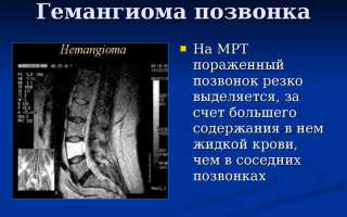 Гемангиолипома позвонка: причины и лечение