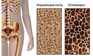Остеопороз позвоночника — симптомы и лечение, важные рекомендации