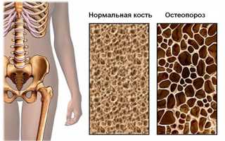 Остеопороз позвоночника — симптомы и лечение, важные рекомендации