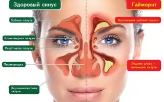 Гайморит, протекающий без насморка и заложенности: симптомы и лечение