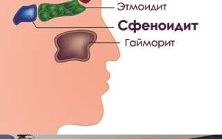 Симптоматика и терапия сфеноидита: причины и лечение