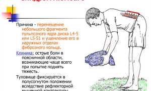 Люмбаго (прострел в пояснице) – причины и лечение