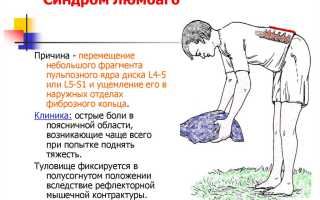 Люмбаго (прострел в пояснице) – причины и лечение