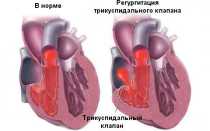 Митральная и трикуспидальная регургитация