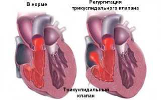 Митральная и трикуспидальная регургитация