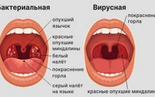 Симптомы и лечение ангины у детей: полезные советы и рекомендации