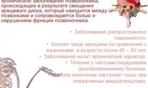 Лечение грыжи позвоночника без операции народными средствами в домашних условиях