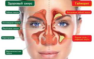 Причины заложенного носа и их последствия