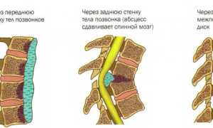 Туберкулез позвоночника: причины и лечение