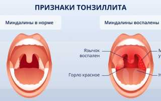 Методы лечения язв в области горла: эффективные подходы и рекомендации