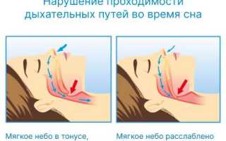 Причины появления храпа у женщин во время беременности и их последствия