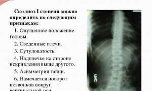 Сколиоз 1 степени: причины, симптомы, диагностика, лечение и профилактика