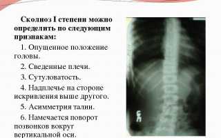 Сколиоз 1 степени: причины, симптомы, диагностика, лечение и профилактика