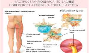 Ишиалгия: симптомы и лечение, важные аспекты здоровья