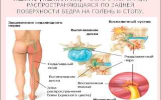 Ишиалгия: симптомы и лечение, важные аспекты здоровья