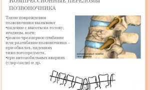 Перелом позвоночника: восстановление после травмы и реабилитация