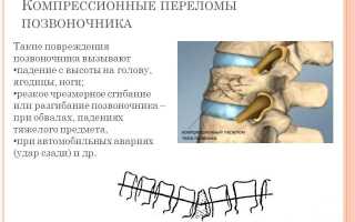 Перелом позвоночника: восстановление после травмы и реабилитация