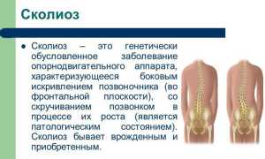 Боковое искривление позвоночника: причины и последствия