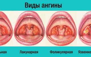 Признаки и методы лечения ангины у взрослых