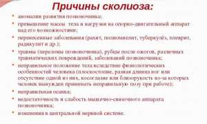 Левосторонний сколиоз: причины и лечение