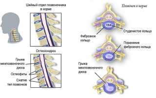 Лечение крапивой при шейном остеохондрозе: эффективные методы и рекомендации