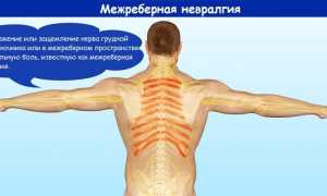 Межреберная невралгия – код по МКБ-10 и симптомы