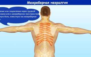 Межреберная невралгия – код по МКБ-10 и симптомы