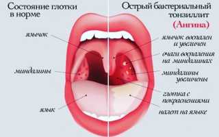 О чем свидетельствует горло красного цвета, каковы методы лечения симптома и их эффективность