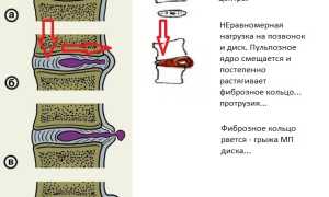 Грыжа диска L5 и S1: что это и как лечить