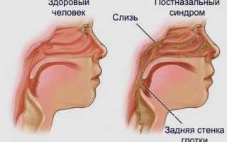 Методы избавления от соплей в горле: советы и рекомендации
